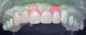 Abb. 13a: Abnehmbare Zahnfleischmaske und Set-up mit Konfektionszähnen.