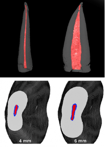 Afb.8: CT-scan van ovaal wortelkanaal en gereinigd met SAF instrumenten. © JOE, 2010 Metzger et al.