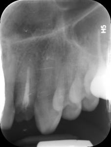 2. Röntgenbild von Zahn 22.