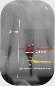 Abb. 7a: Vertikaler Abstand zwischen marginalem Knochen und Kontaktpunkt dürften nicht grösser als 5 mm sein.