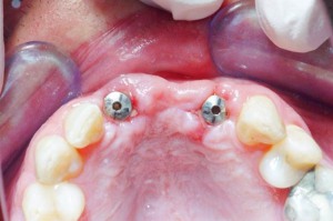 Abb. 9a: Der Gingivaformer für Zahn 21 hat den richtigen Durchmesser. Der Gingivaformer für Zahn 12 hat einen zu kleinen Durchmesser.